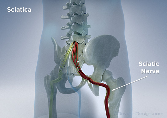 Sciatica