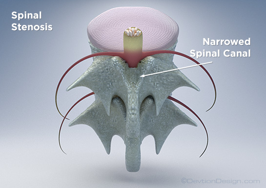 Spinal Stenosis